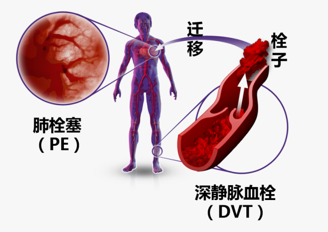 《2023年国家医疗质量安全改进目标》再次强调“提高VTE规范预防率”
