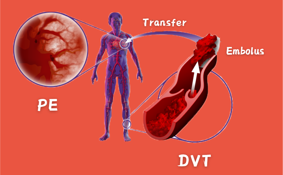 PGx for VTE Risk Assessment